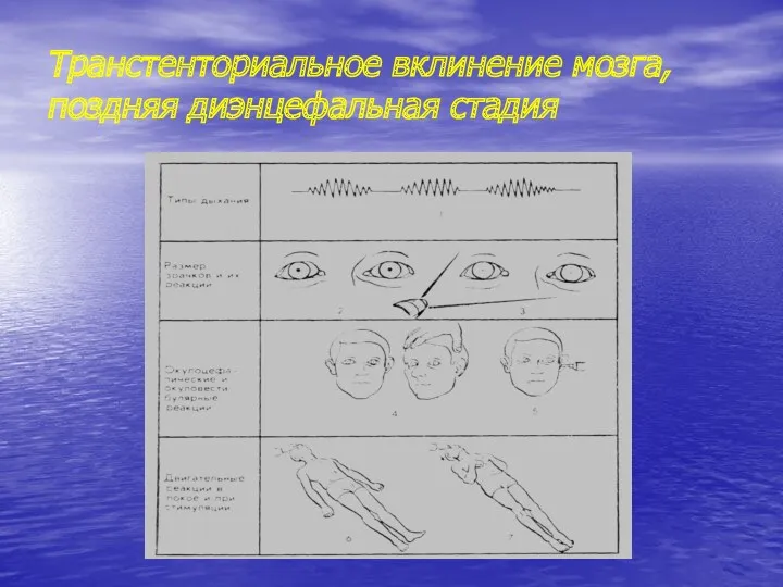 Транстенториальное вклинение мозга, поздняя диэнцефальная стадия