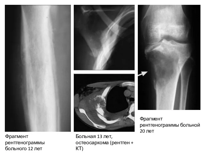 Фрагмент рентгенограммы больного 12 лет Больная 13 лет, остеосаркома (рентген