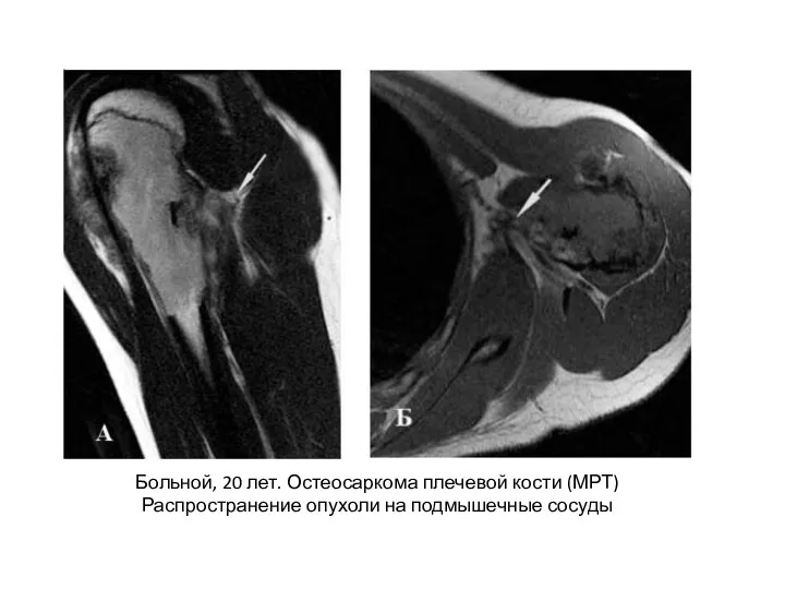 Больной, 20 лет. Остеосаркома плечевой кости (МРТ) Распространение опухоли на подмышечные сосуды
