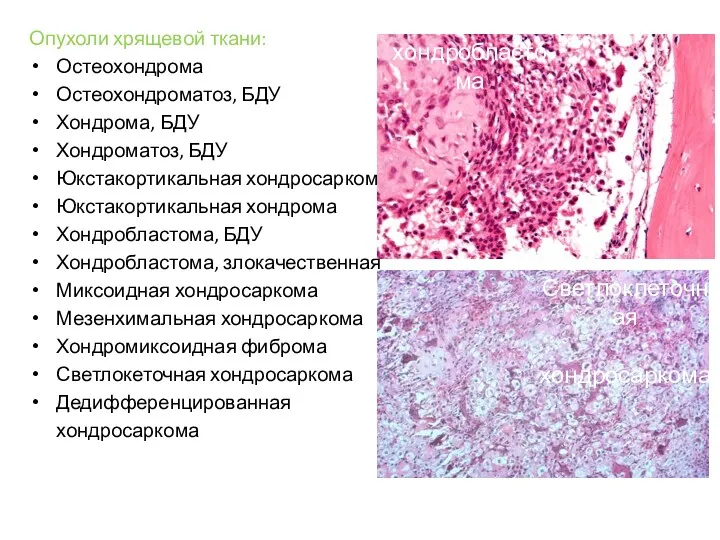 Опухоли хрящевой ткани: Остеохондрома Остеохондроматоз, БДУ Хондрома, БДУ Хондроматоз, БДУ Юкстакортикальная хондросаркома Юкстакортикальная