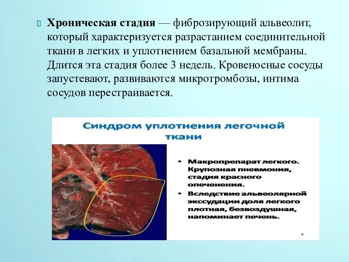 Хроническая стадия — фиброзирующий альвеолит, который характеризуется разрастанием соединительной ткани