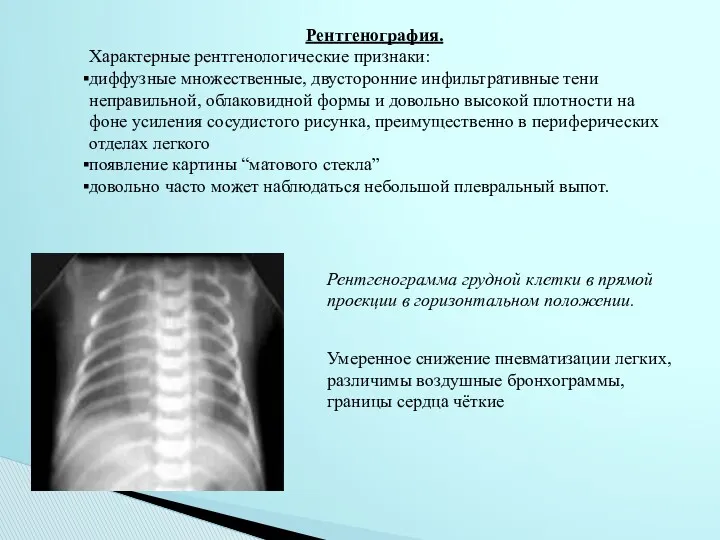 Рентгенография. Характерные рентгенологические признаки: диффузные множественные, двусторонние инфильтративные тени неправильной,