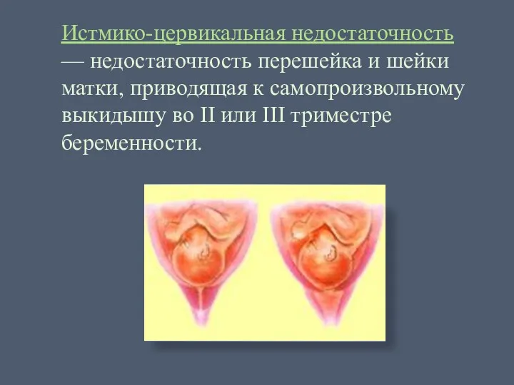 Истмико-цервикальная недостаточность — недостаточность перешейка и шейки матки, приводящая к