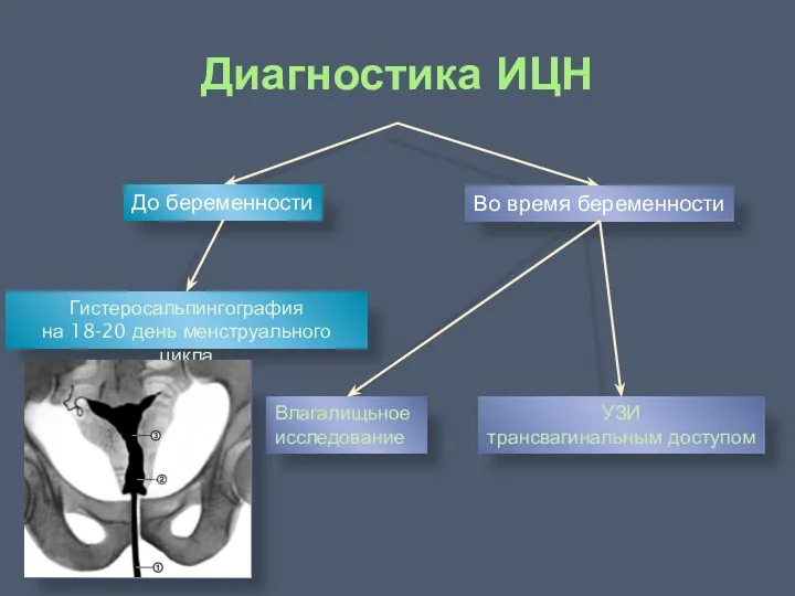 Диагностика ИЦН До беременности Во время беременности Гистеросальпингография на 18-20