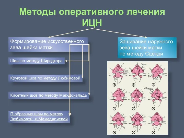 Методы оперативного лечения ИЦН Формирование искусственного зева шейки матки Зашивание