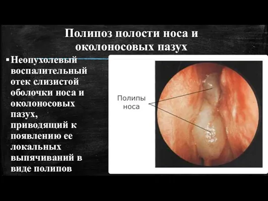 Полипоз полости носа и околоносовых пазух Неопухолевый воспалительный отек слизистой