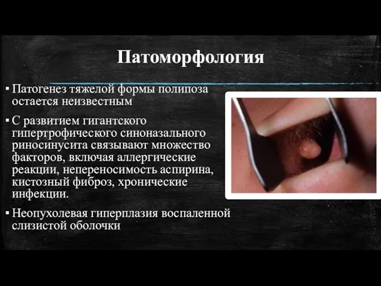 Патоморфология Патогенез тяжелой формы полипоза остается неизвестным С развитием гигантского