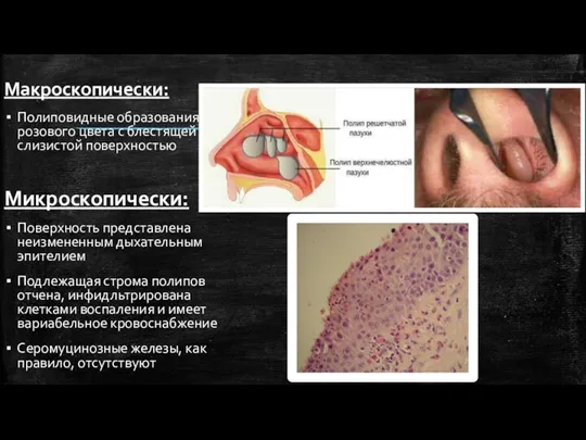 Макроскопически: Полиповидные образования розового цвета с блестящей слизистой поверхностью Микроскопически: