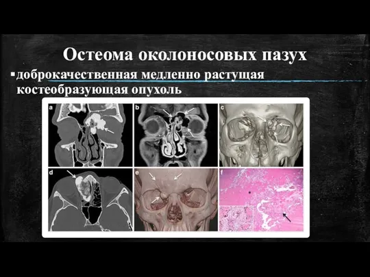 Остеома околоносовых пазух доброкачественная медленно растущая костеобразующая опухоль