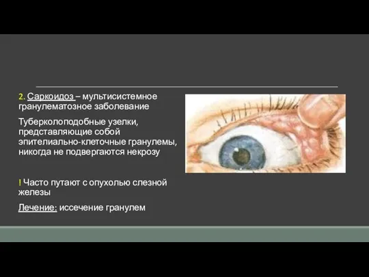 2. Саркоидоз – мультисистемное гранулематозное заболевание Туберколоподобные узелки, представляющие собой