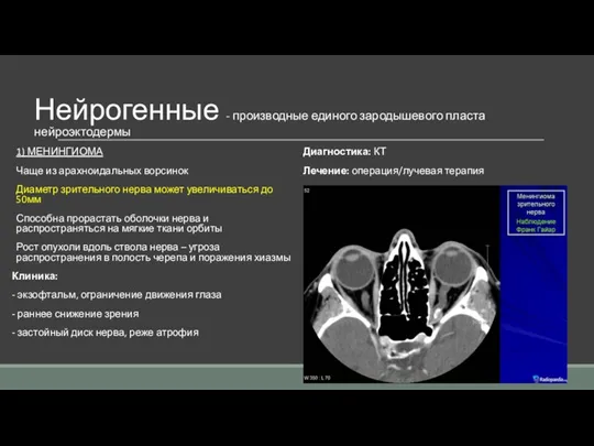 Нейрогенные - производные единого зародышевого пласта нейроэктодермы 1) МЕНИНГИОМА Чаще