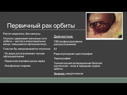 Первичный рак орбиты Растет медленно, без капсулы Опухоль сдавливает венозные