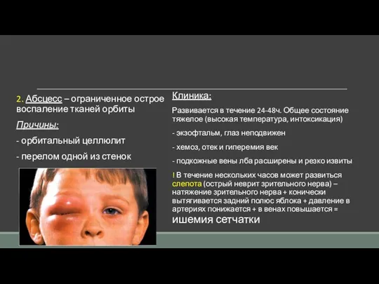 2. Абсцесс – ограниченное острое воспаление тканей орбиты Причины: -