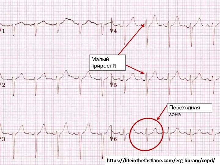 Переходная зона Малый прирост R https://lifeinthefastlane.com/ecg-library/copd/