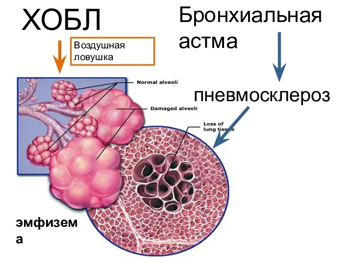 пневмосклероз ХОБЛ Бронхиальная астма Воздушная ловушка эмфизема