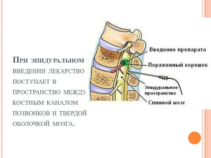 При эпидуральном введении лекарство поступает в пространство между костным каналом позвонков и твердой оболочкой мозга.