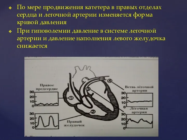По мере продвижения катетера в правых отделах сердца и легочной