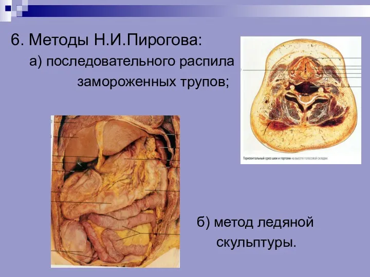 6. Методы Н.И.Пирогова: а) последовательного распила замороженных трупов; б) метод ледяной скульптуры.