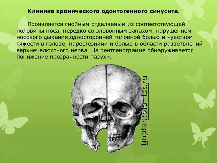 Клиника хронического одонтогенного синусита. Проявляется гнойным отделяемым из соответствующей половины