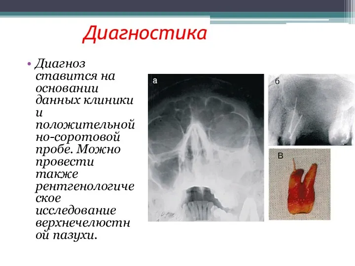 Диагностика Диагноз ставится на основании данных клиники и положительной но-соротовой пробе. Можно провести