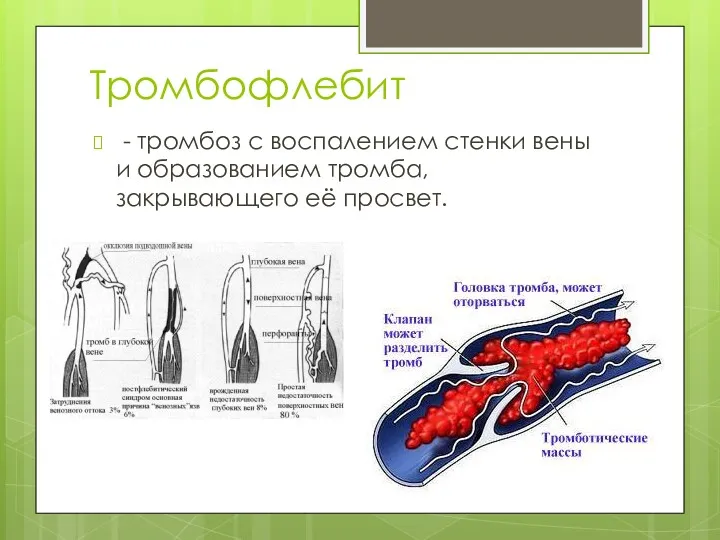 Тромбофлебит - тромбоз с воспалением стенки вены и образованием тромба, закрывающего её просвет.