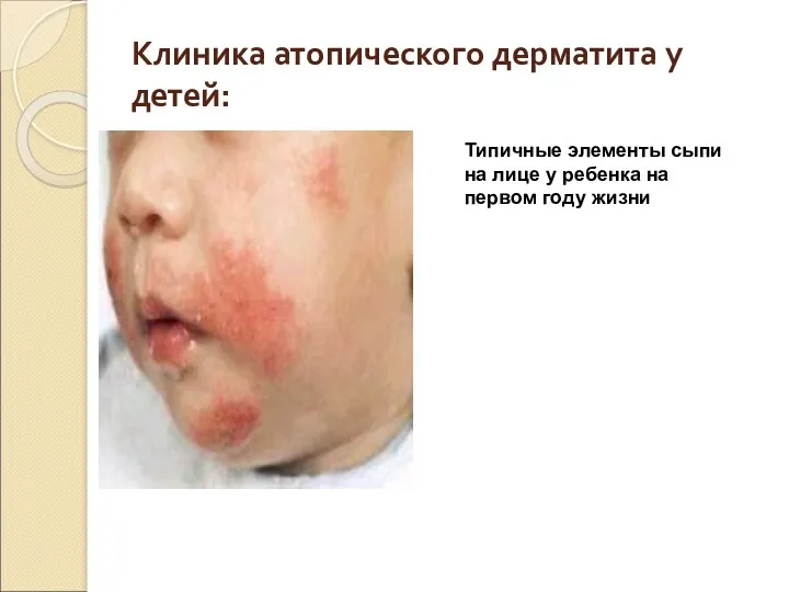 Клиника атопического дерматита у детей: Типичные элементы сыпи на лице у ребенка на первом году жизни
