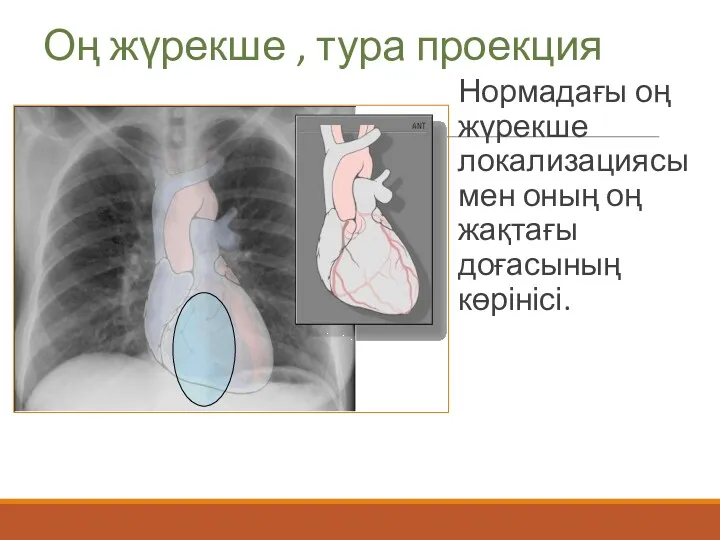 Оң жүрекше , тура проекция Нормадағы оң жүрекше локализациясы мен оның оң жақтағы доғасының көрінісі.