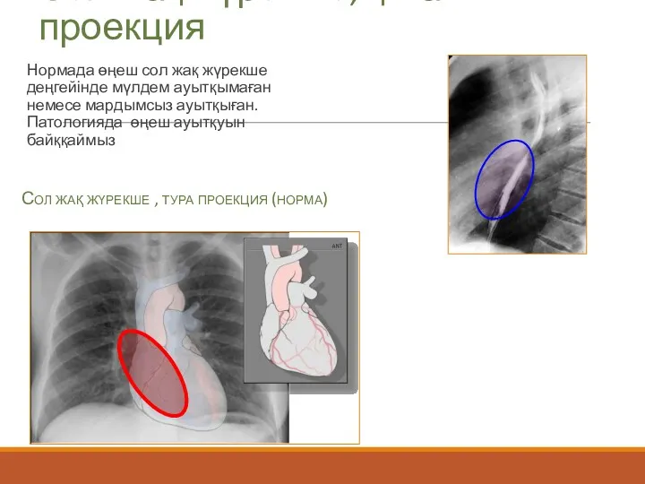 Сол жақ жүрекше, қиғаш проекция Нормада өңеш сол жақ жүрекше