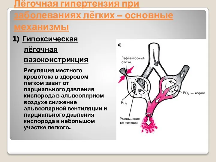 Лёгочная гипертензия при заболеваниях лёгких – основные механизмы 1) Гипоксическая