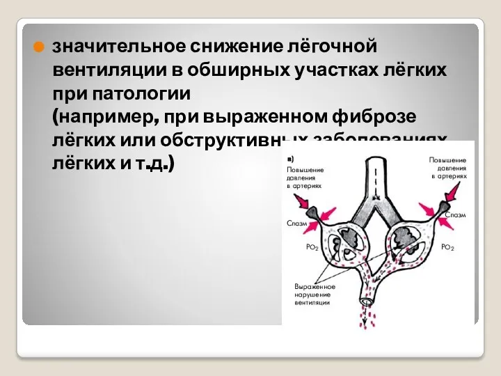 значительное снижение лёгочной вентиляции в обширных участках лёгких при патологии