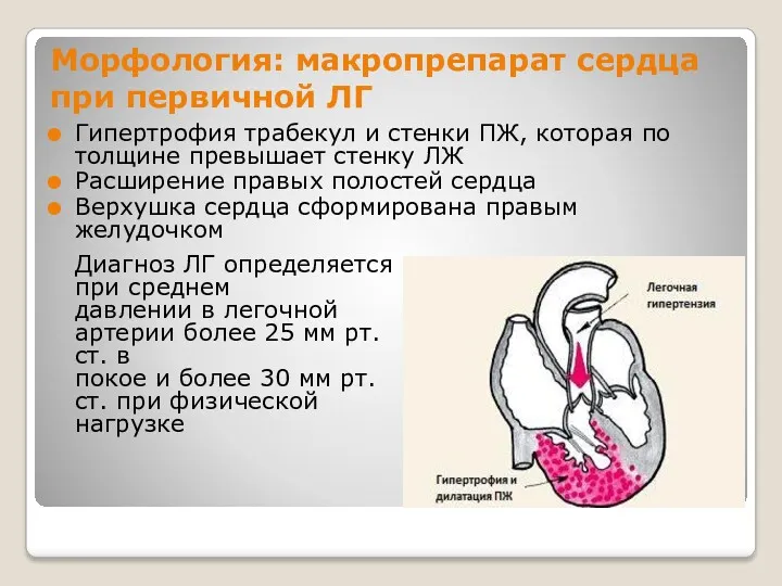 Морфология: макропрепарат сердца при первичной ЛГ Гипертрофия трабекул и стенки