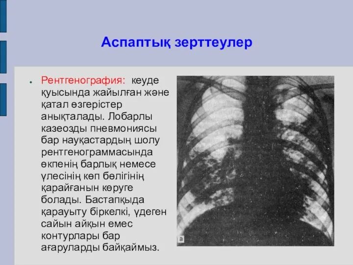 Аспаптық зерттеулер Рентгенография: кеуде қуысында жайылған және қатал өзгерістер анықталады.