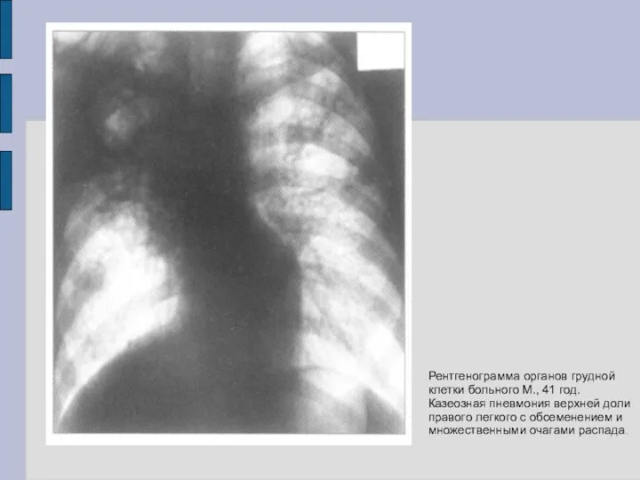 Рентгенограмма органов грудной клетки больного М., 41 год. Казеозная пневмония