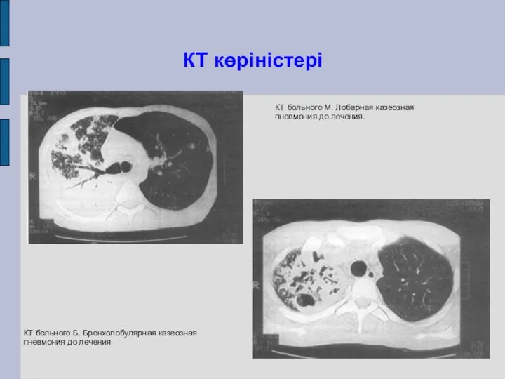 КТ көріністері КТ больного Б. Бронхолобулярная казеозная пневмония до лечения.