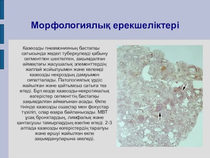 Морфологиялық ерекшеліктері Казеозды пневмонияның бастапқы сатысында жедел туберкулезді қабыну сегментпен