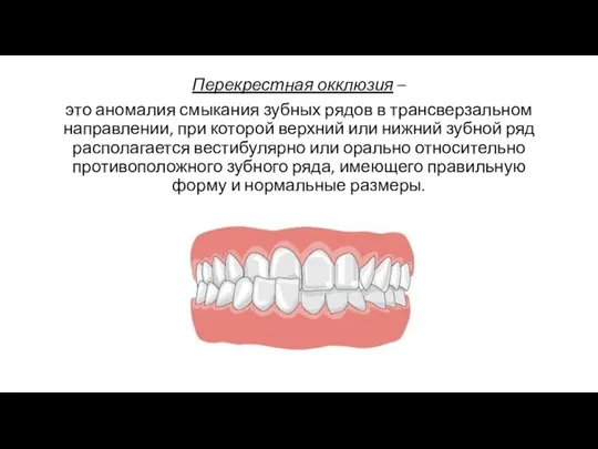 Перекрестная окклюзия – это аномалия смыкания зубных рядов в трансверзальном