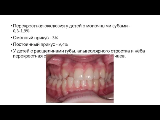 Перекрестная окклюзия у детей с молочными зубами - 0,3-1,9% Сменный