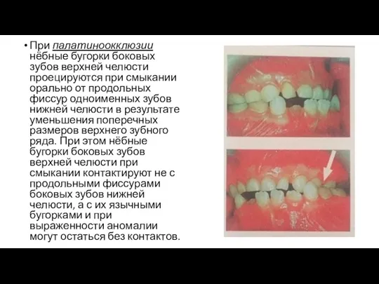При палатиноокклюзии нёбные бугорки боковых зубов верхней челюсти проецируются при
