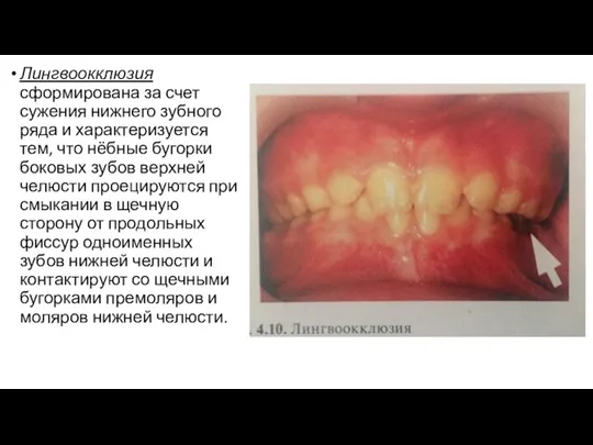 Лингвоокклюзия сформирована за счет сужения нижнего зубного ряда и характеризуется