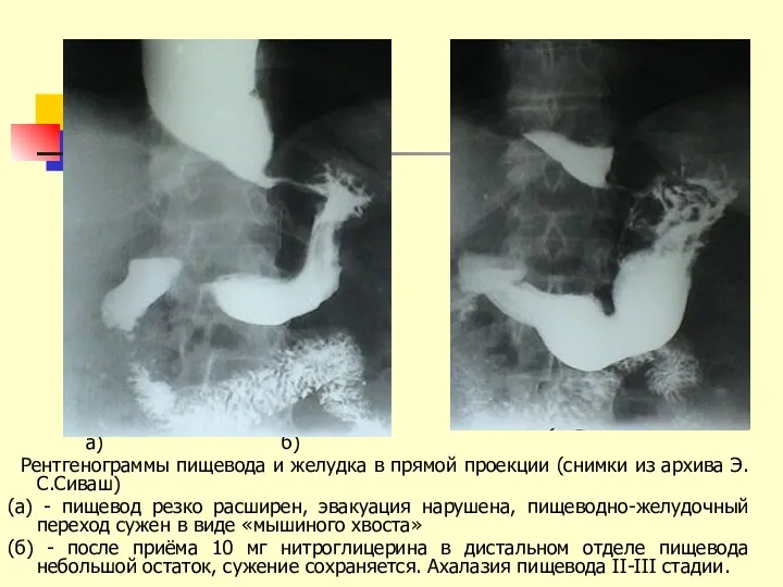 а) б) Рентгенограммы пищевода и желудка в прямой проекции (снимки из архива Э.С.Сиваш)