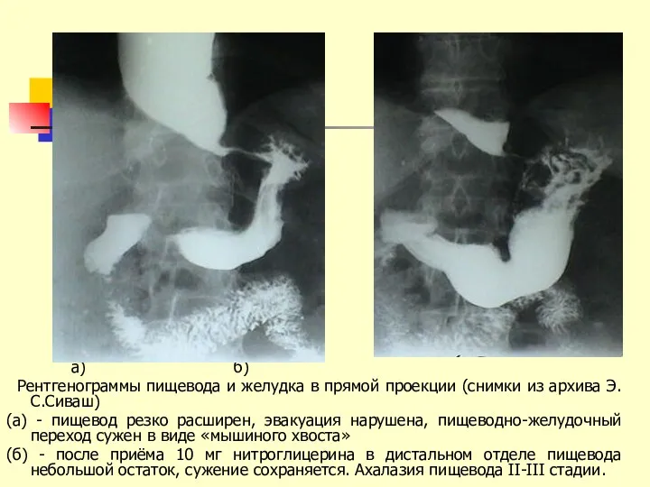 а) б) Рентгенограммы пищевода и желудка в прямой проекции (снимки