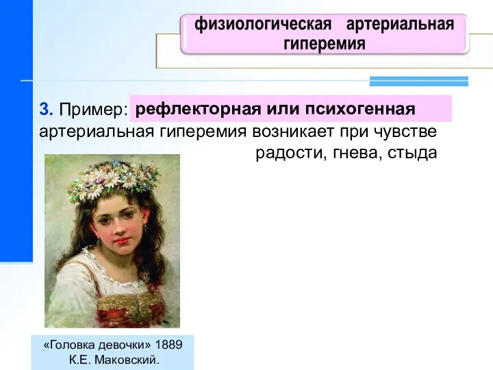 «Головка девочки» 1889 К.Е. Маковский. рефлекторная или психогенная 3. Пример: