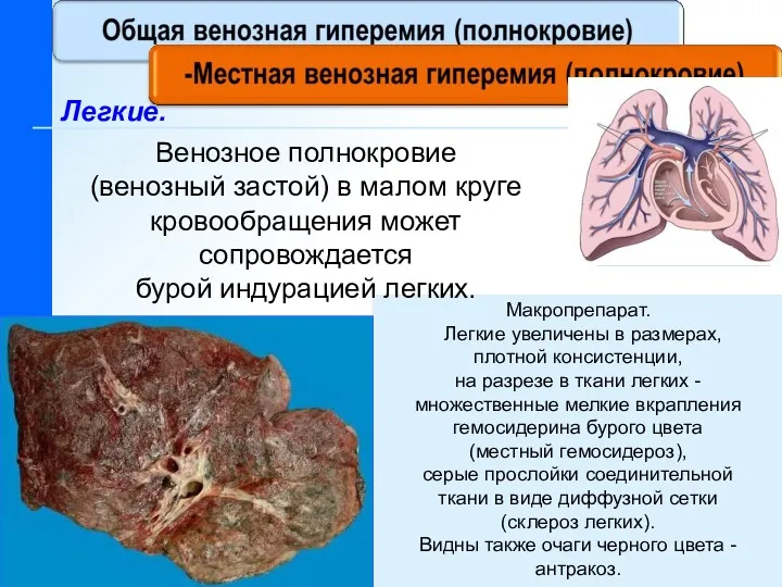 Легкие. Макропрепарат. Легкие увеличены в размерах, плотной консистенции, на разрезе