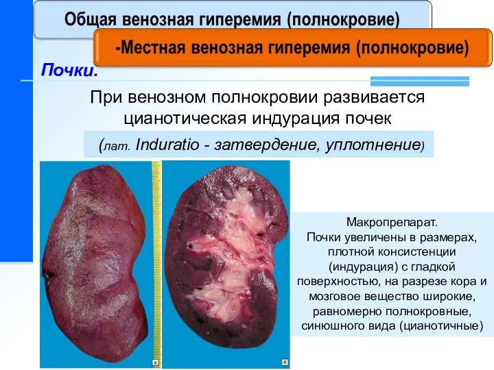 При венозном полнокровии развивается цианотическая индурация почек Почки. (лат. Induratio