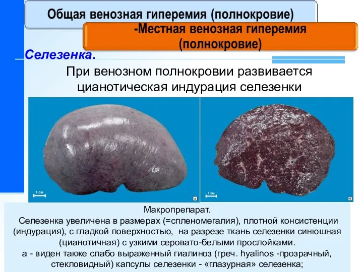 При венозном полнокровии развивается цианотическая индурация селезенки Селезенка. Макропрепарат. Селезенка