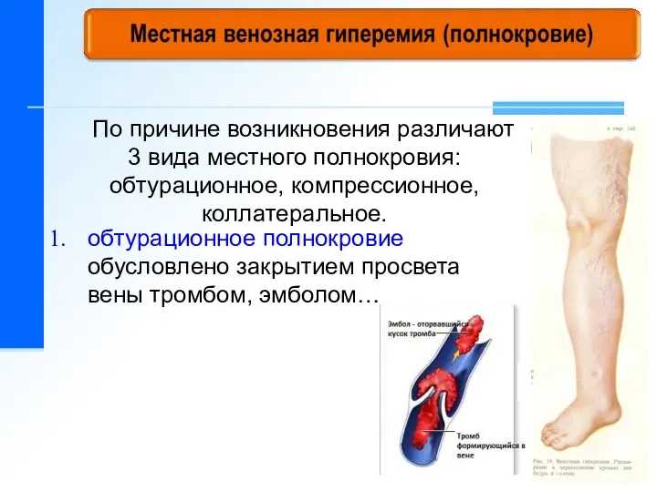 По причине возникновения различают 3 вида местного полнокровия: обтурационное, компрессионное,