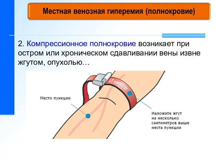 2. Компрессионное полнокровие возникает при остром или хроническом сдавливании вены извне жгутом, опухолью…