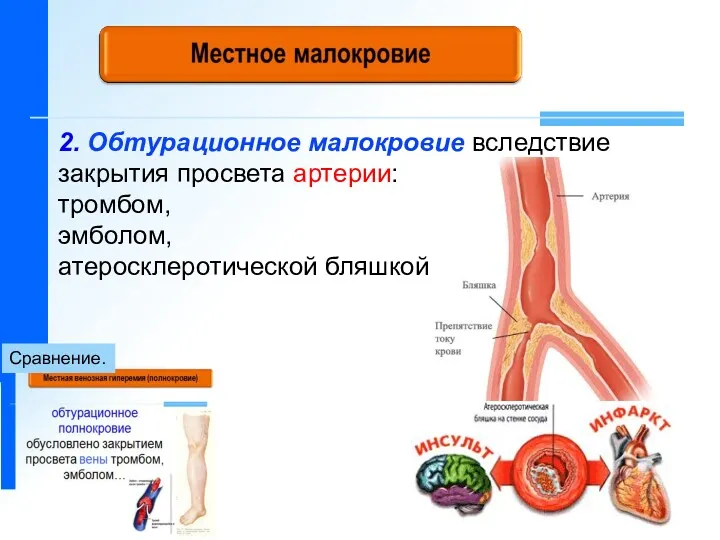 2. Обтурационное малокровие вследствие закрытия просвета артерии: тромбом, эмболом, атеросклеротической бляшкой… Сравнение.