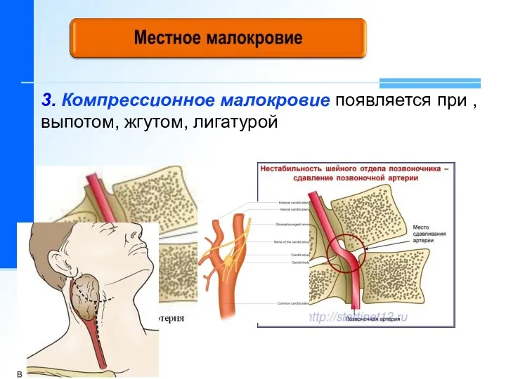 3. Компрессионное малокровие появляется при , выпотом, жгутом, лигатурой