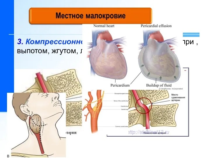 3. Компрессионное малокровие появляется при , выпотом, жгутом, лигатурой